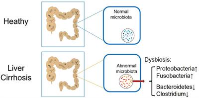 Toll-Like Receptors Recognize Intestinal Microbes in Liver Cirrhosis